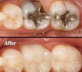 The Silent Killer That A Tooth Crown Can Defeat