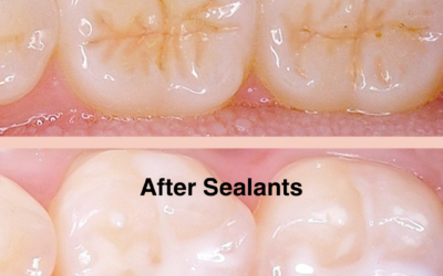 Protect Your Child’s Smile: The Benefits of Dental Sealants