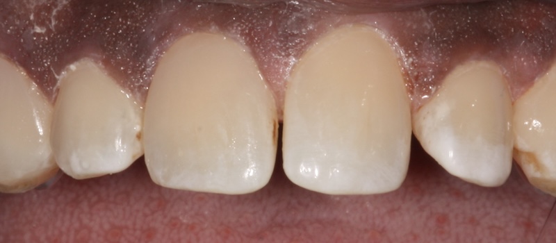 After treatment