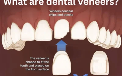 Transform Your Smile with Dental Veneers