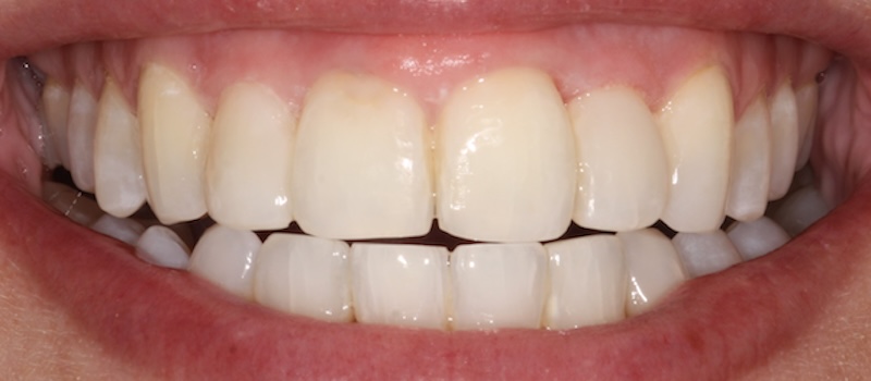 After treatment