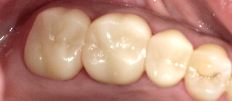 After treatment