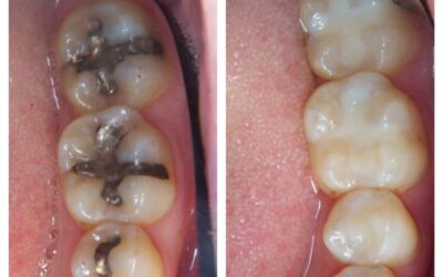 The Importance of Replacing Old Silver Fillings