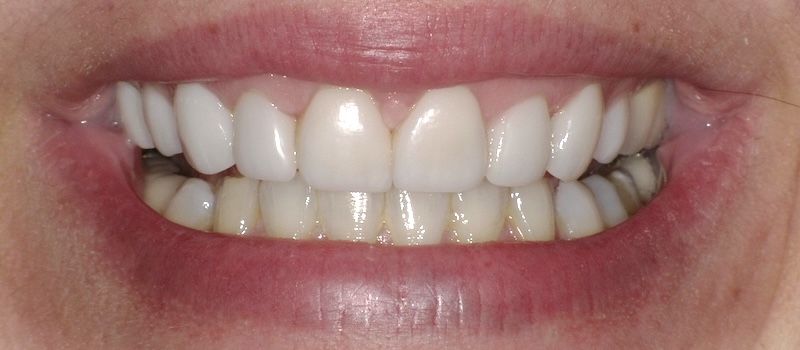 After treatment