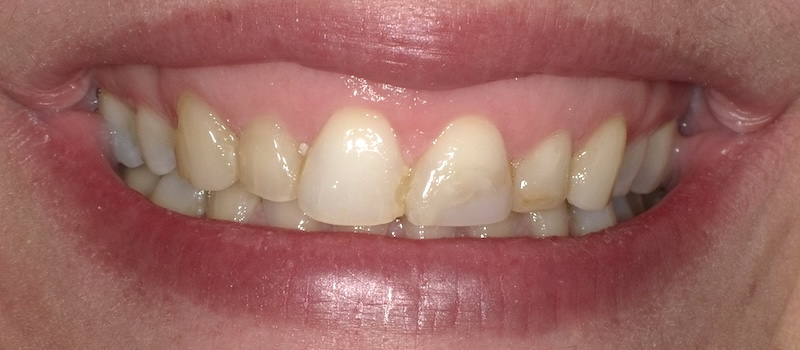 Before treatment